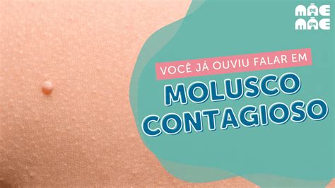 como eliminar molusco contagioso naturalmente|Molusco contagioso, sintomas, tratamento e remédios。